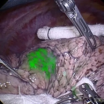 Imagen: VGT-309 es un agente de imágenes fluorescente dirigido a tumores que permite a los cirujanos ver tumores previamente no detectados o difíciles de encontrar en tiempo real (foto cortesía de Vergent Bioscience)